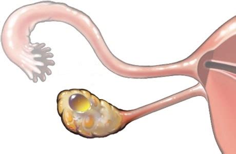 varicele ovariene la bărbați pot avea copii